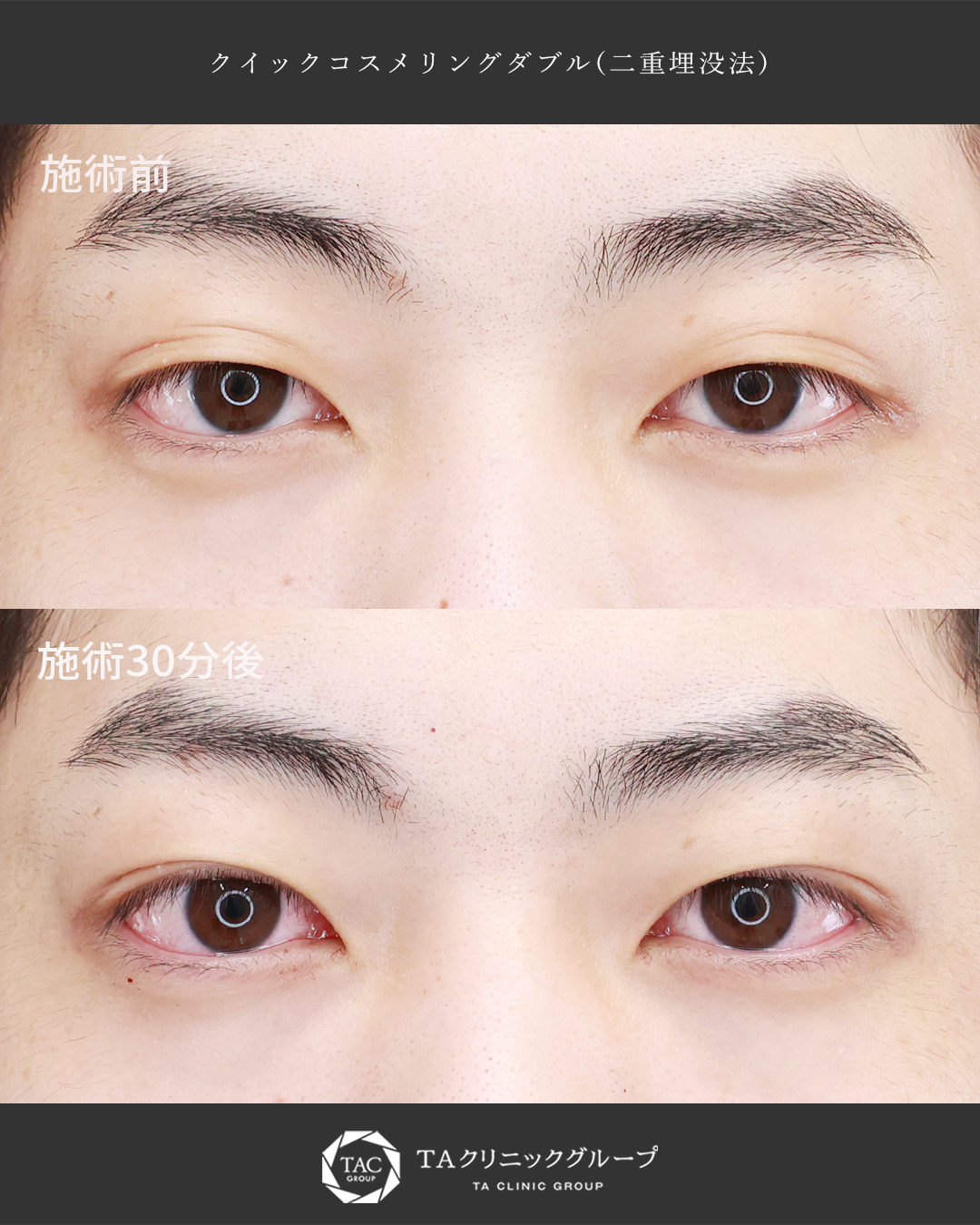 直後から腫れづらい│メンズ【二重埋没法】