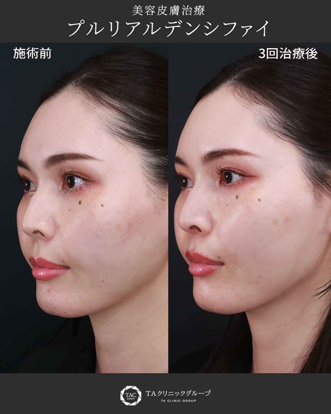 【プルリアルデンシファイ】複数回施術で‟すっぴん力、アガる肌”
