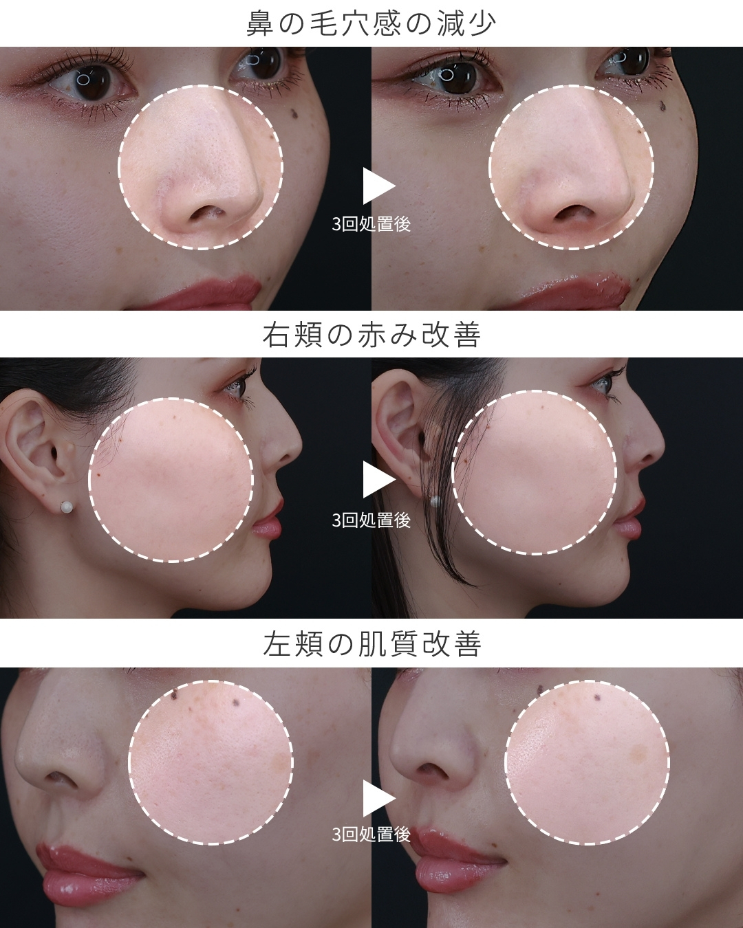 プルリアルデンシファイの症例写真 施術前後 