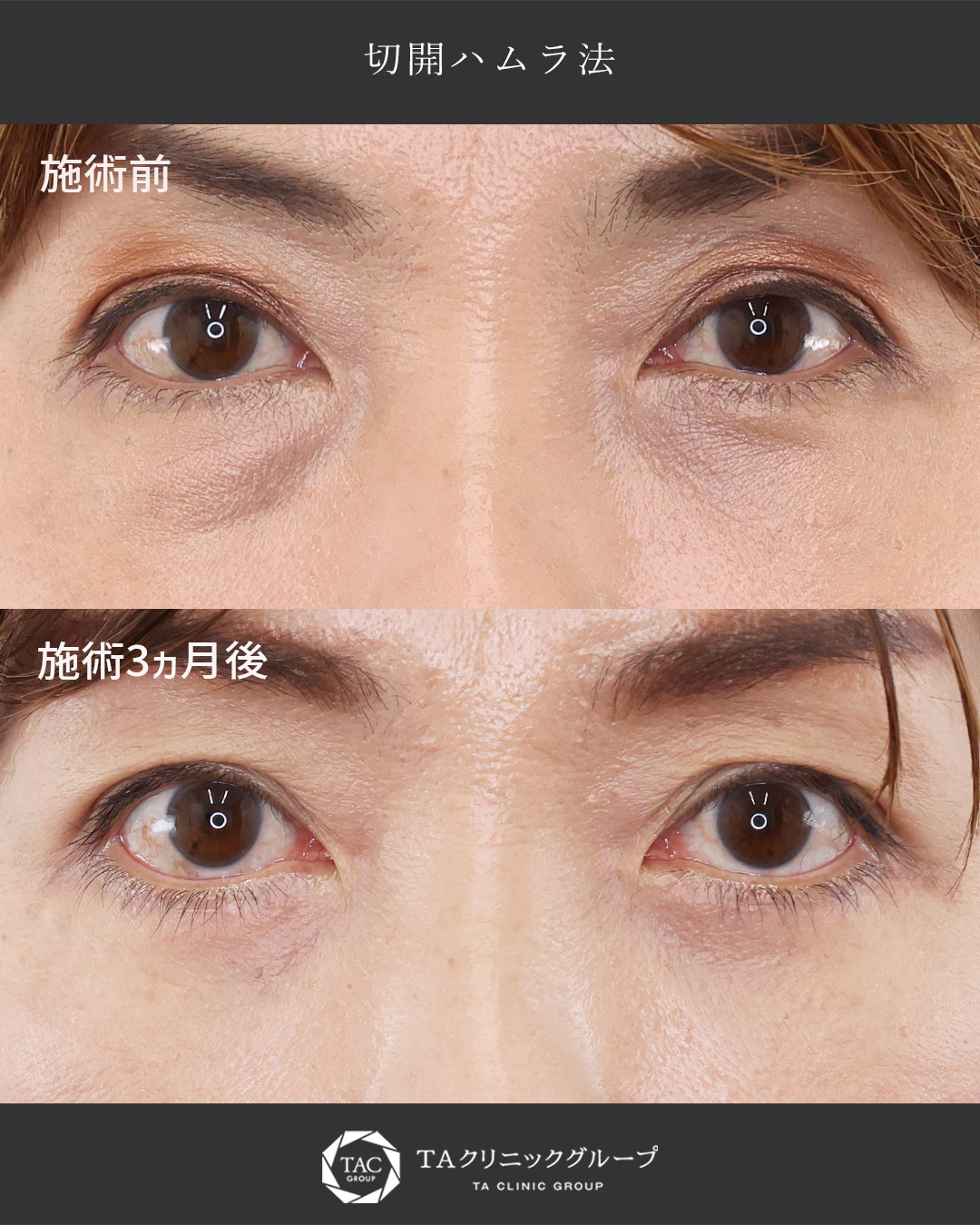 【50代のクマ・たるみ改善】切開ハムラ法で叶える、10年前のハリのある目元