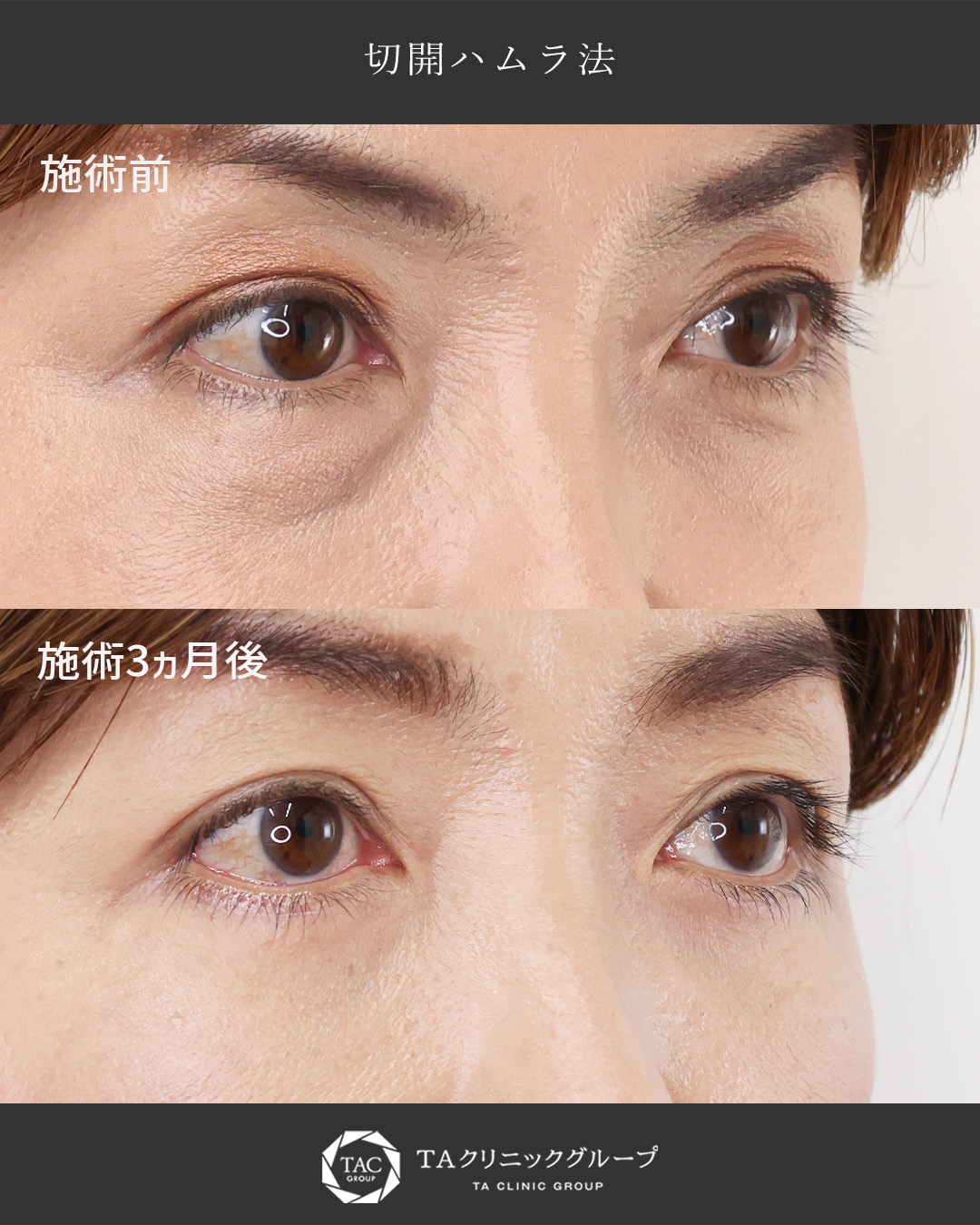 下眼瞼切開術（クマ・たるみとり）の症例写真 施術前後 