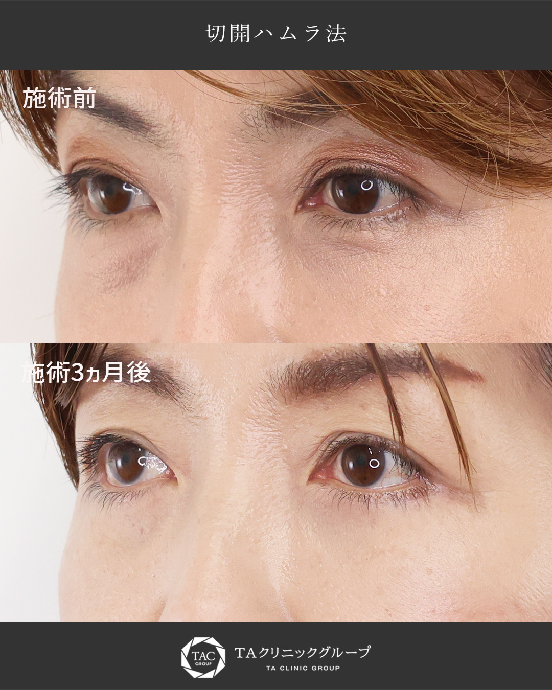 下眼瞼切開術（クマ・たるみとり）の症例写真 施術前後 