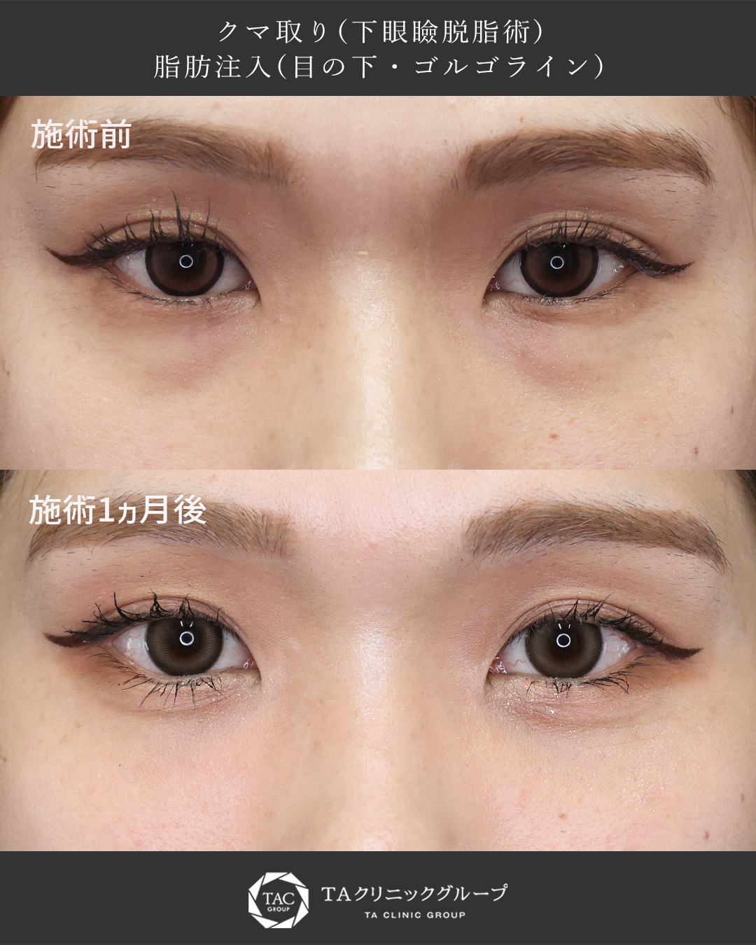 20代女性のクマ取り症例｜下眼瞼脱脂＋脂肪注入で、メイクで隠せない影を根本改善