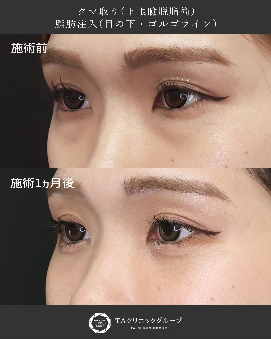 下眼瞼脱脂術（目の下のたるみ取り・目の下の脂肪ふくらみ取り）/顔の脂肪注入(コンデンスリッチフェイス)の症例写真 施術前後 