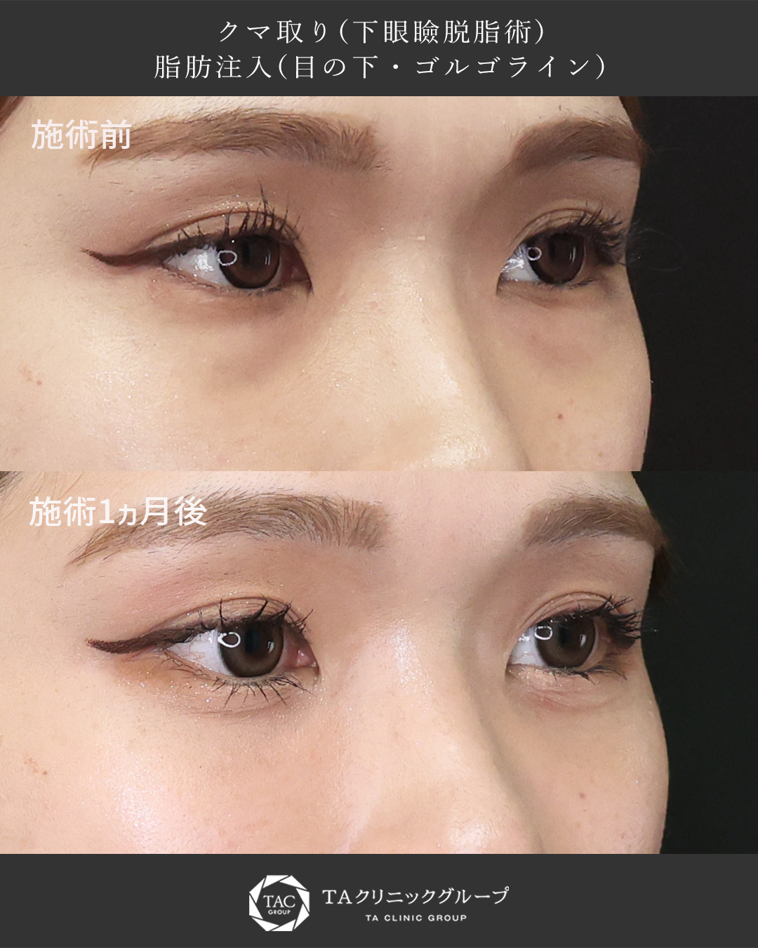 下眼瞼脱脂術（目の下のたるみ取り・目の下の脂肪ふくらみ取り）/顔の脂肪注入(コンデンスリッチフェイス)の症例写真 施術前後 