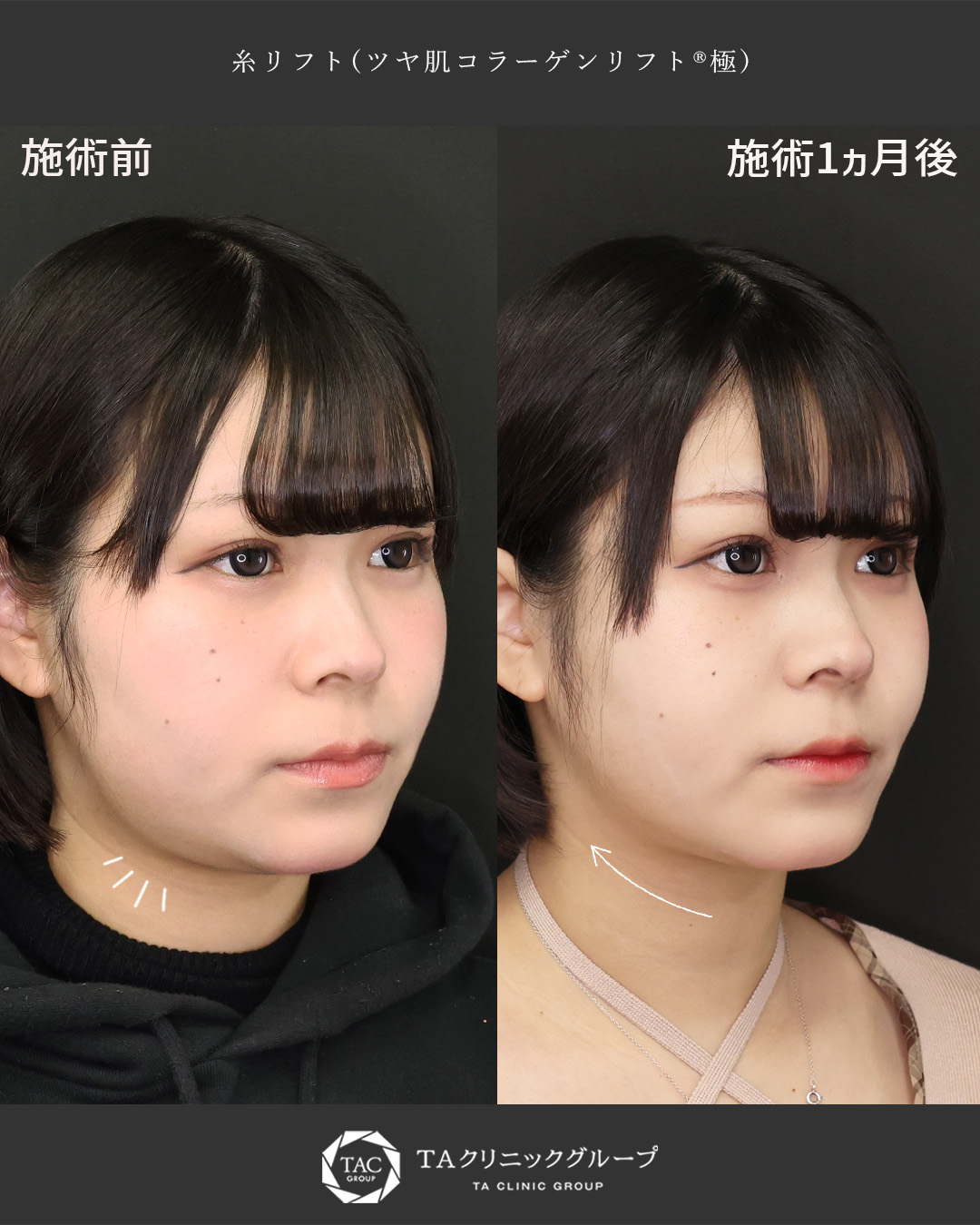 TAC式 ツヤ肌コラーゲンリフト®の症例写真 施術前後 