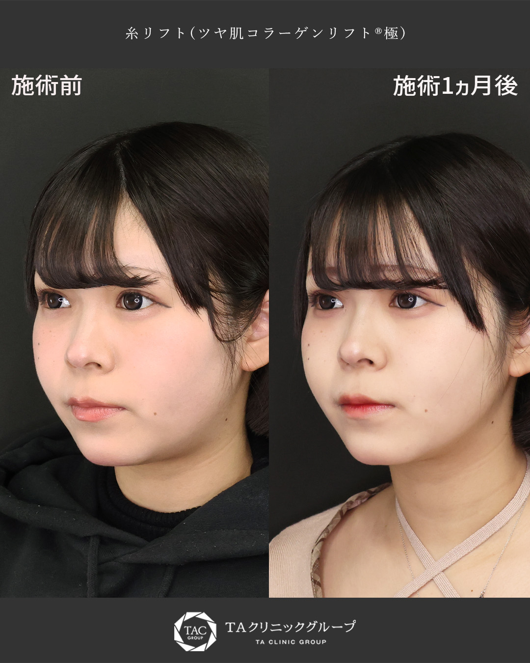 TAC式 ツヤ肌コラーゲンリフト®の症例写真 施術前後 