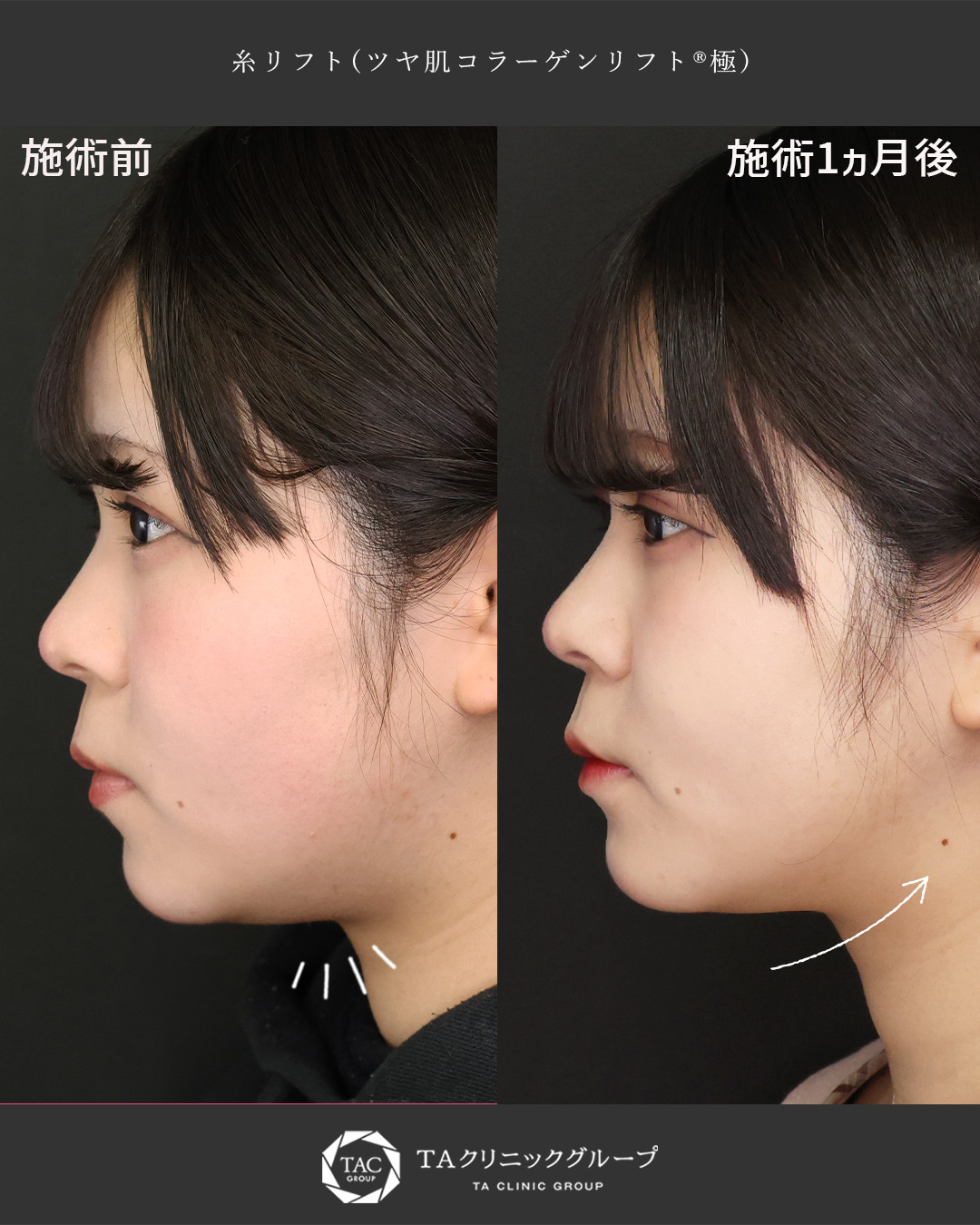 TAC式 ツヤ肌コラーゲンリフト®の症例写真 施術前後 