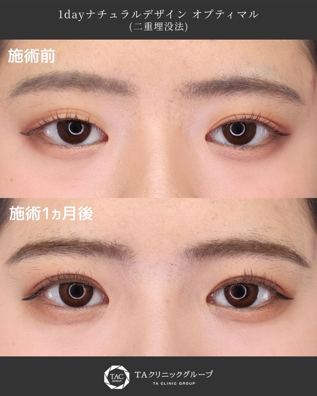 【二重埋没法】“元から二重？”と聞かれる自然な仕上がりに◎