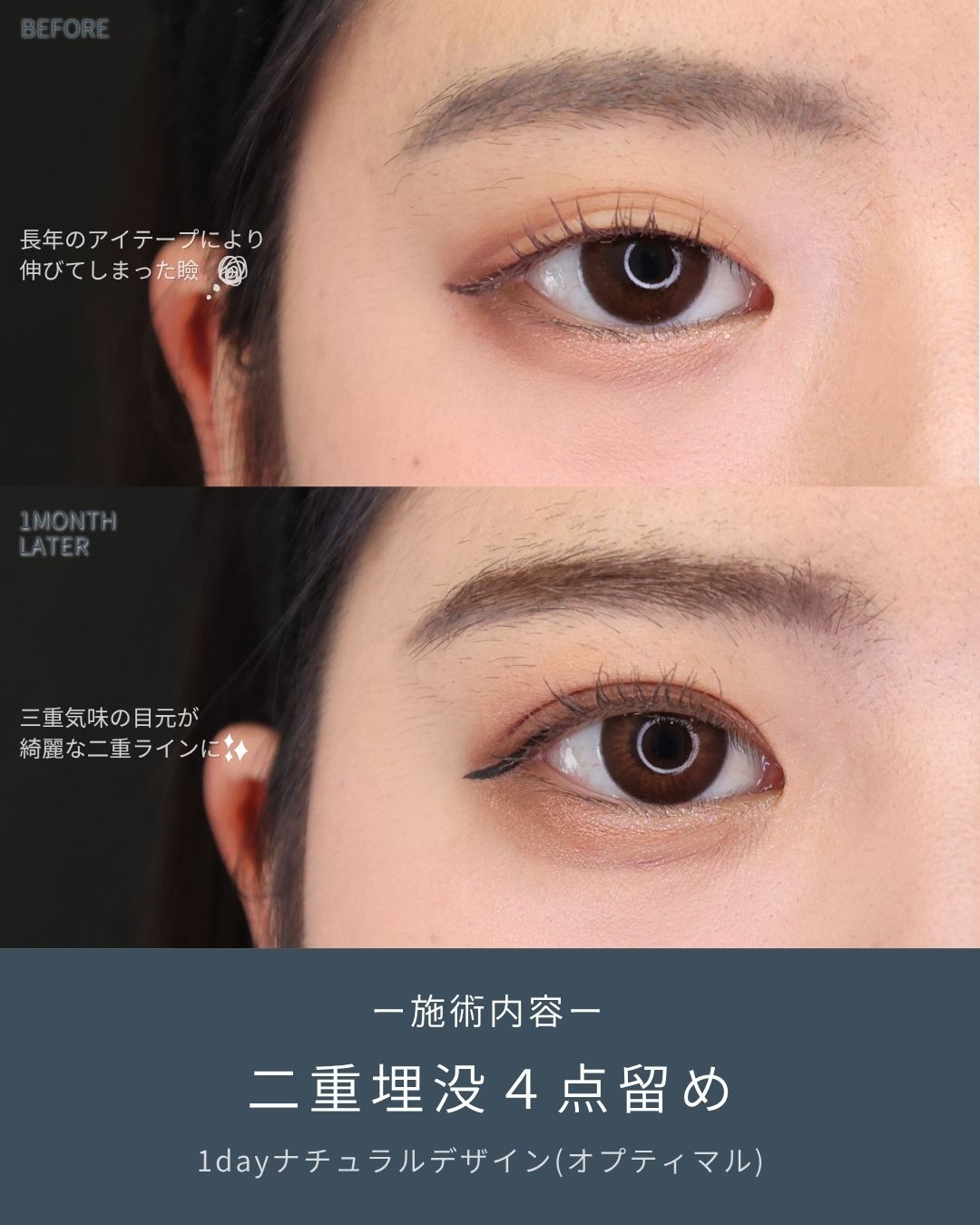 二重埋没法の症例写真 施術前後 