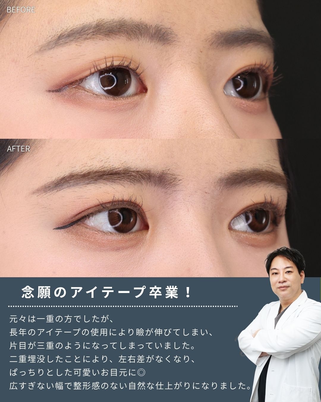 二重埋没法の症例写真 施術前後 