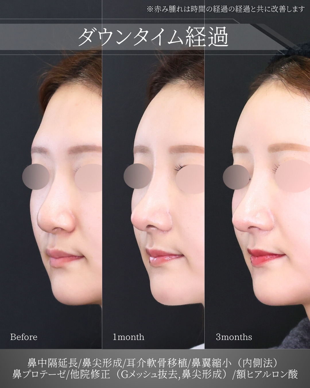 鼻中隔延長術/鼻先軟骨移植/鼻尖形成・鼻尖縮小の症例写真 施術前後 