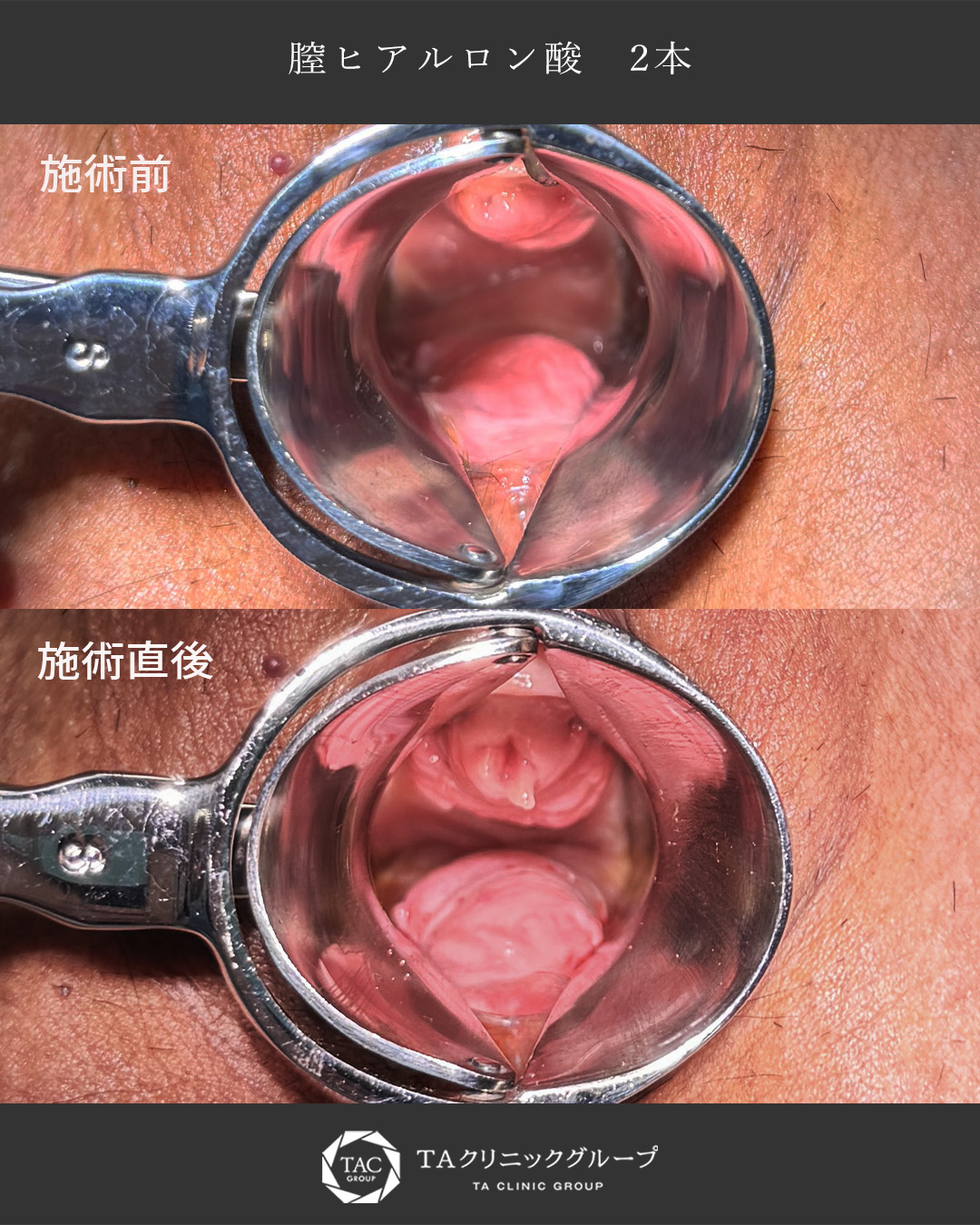 【膣ヒアルロン酸】ハリと弾力を取り戻し、快適な毎日へ