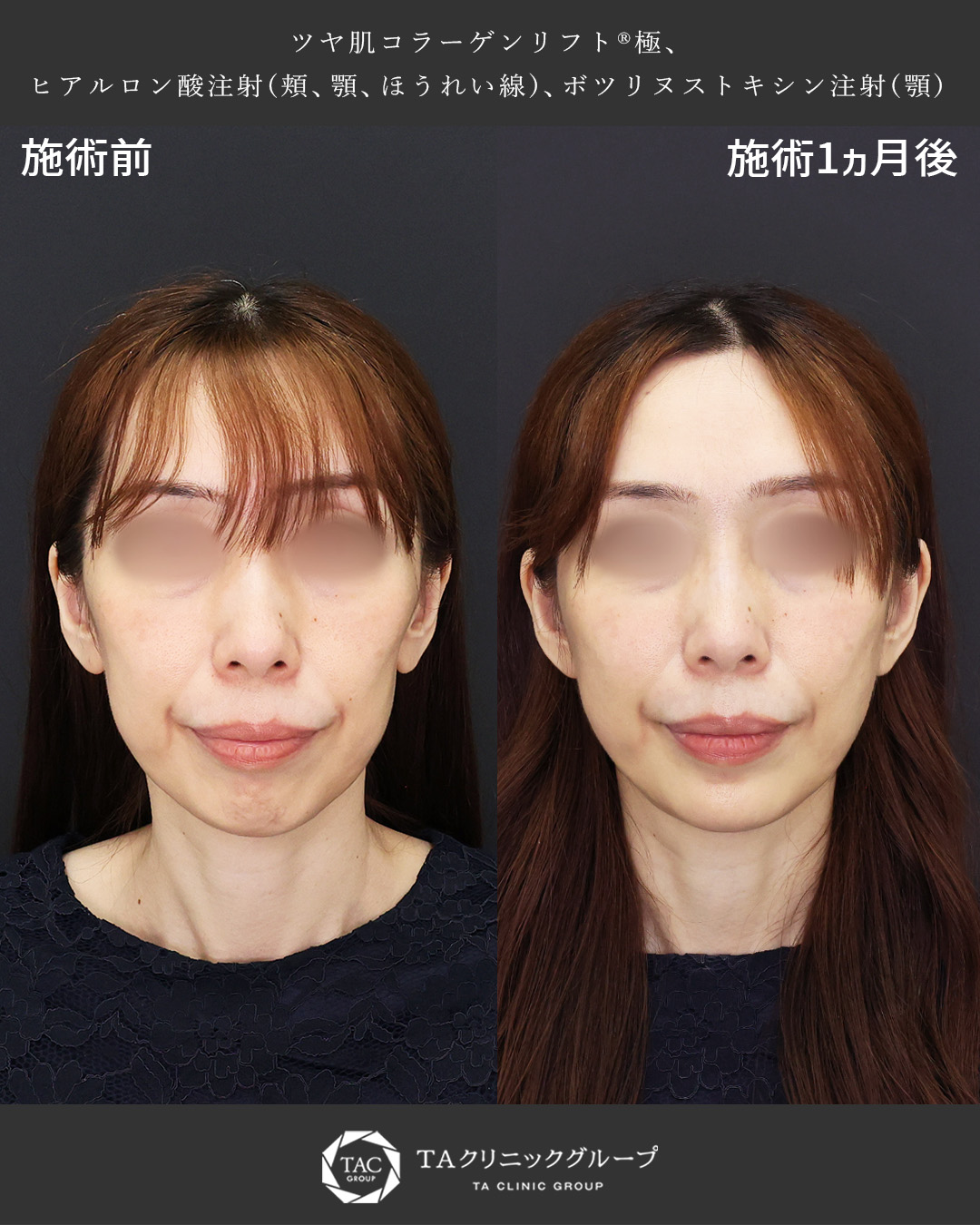 【輪郭で若返り】糸リフト×ヒアルロン酸注射