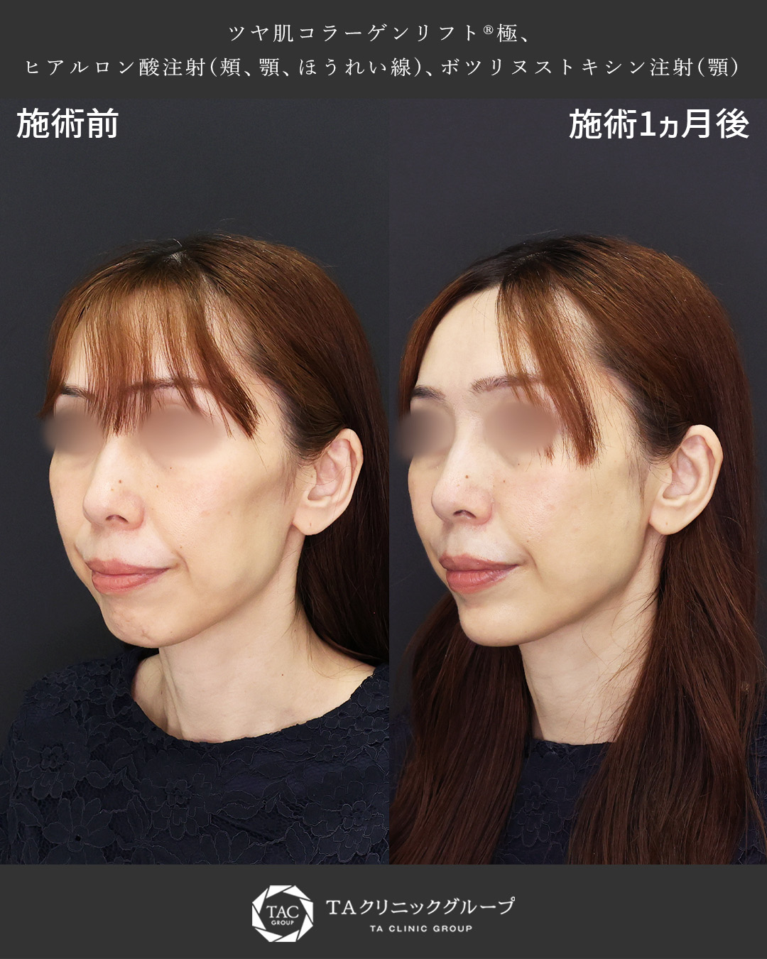 TAC式 ツヤ肌コラーゲンリフト®/ほうれい線のヒアルロン酸注射/ヒアルロン酸注射：その他の症例写真 施術前後 