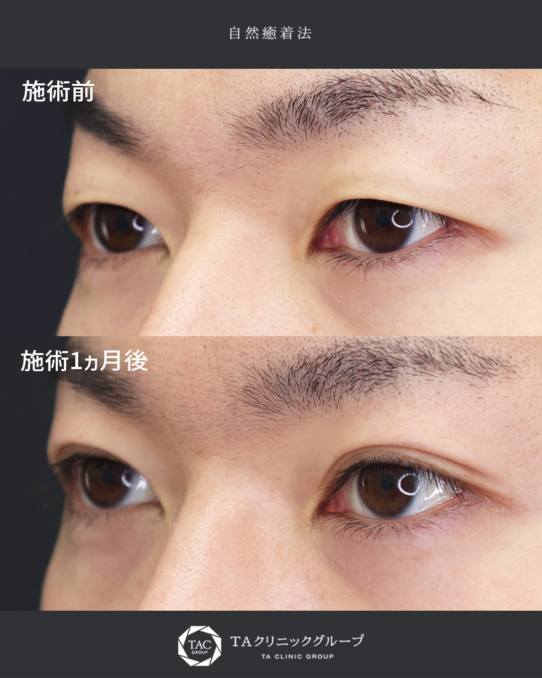 自然癒着法の症例写真 施術前後 