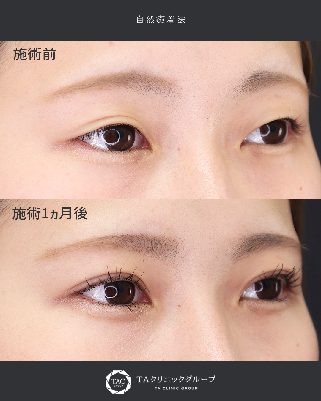 自然癒着法の症例写真 施術前後 