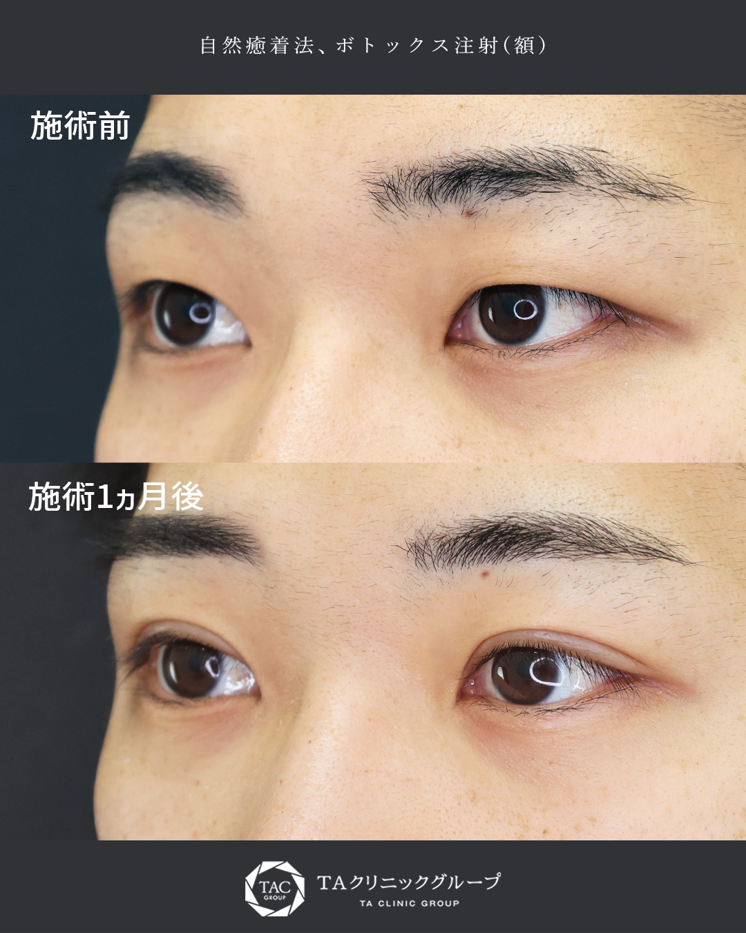 自然癒着法/おでこボトックス注射の症例写真 施術前後 