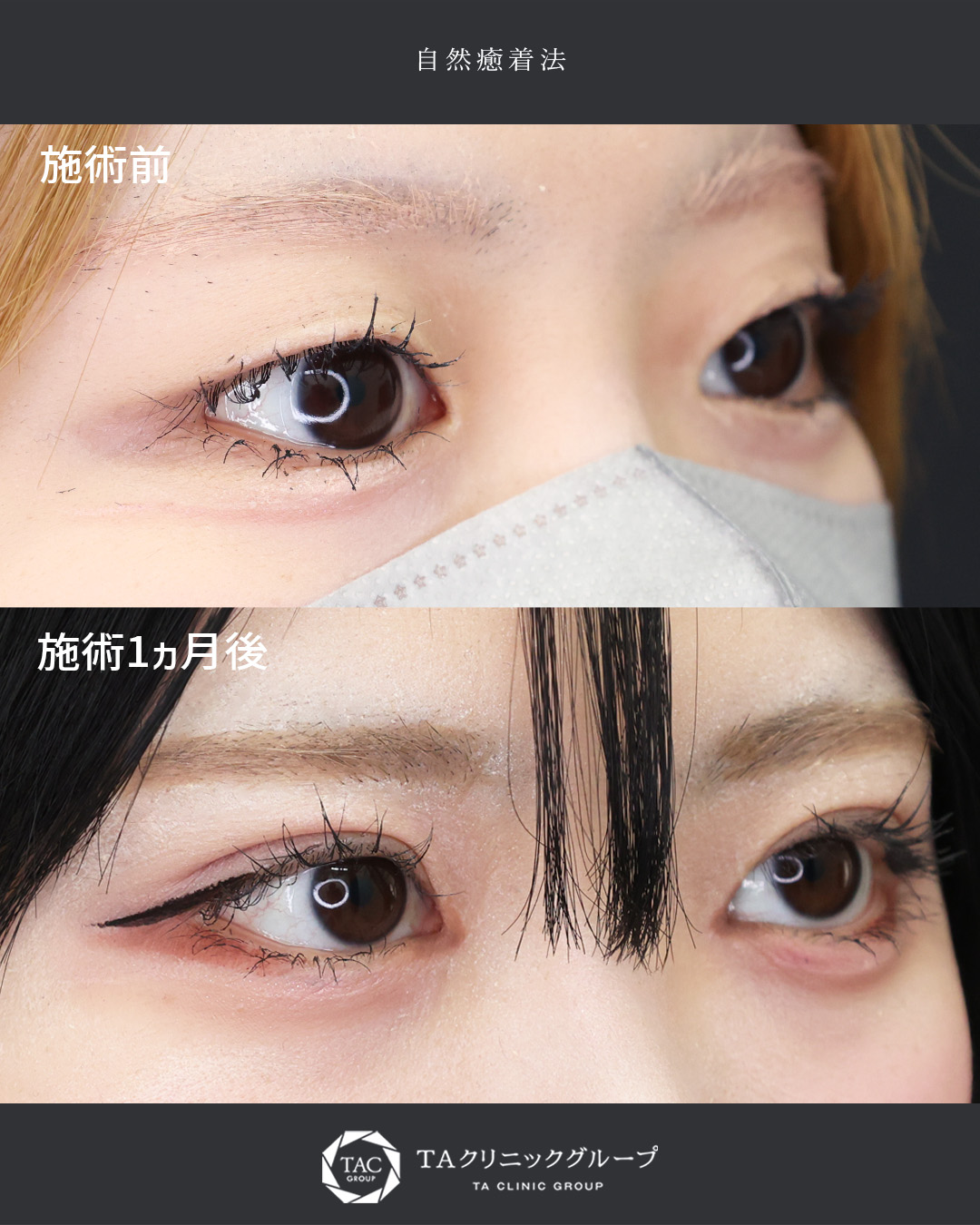 自然癒着法の症例写真 施術前後 