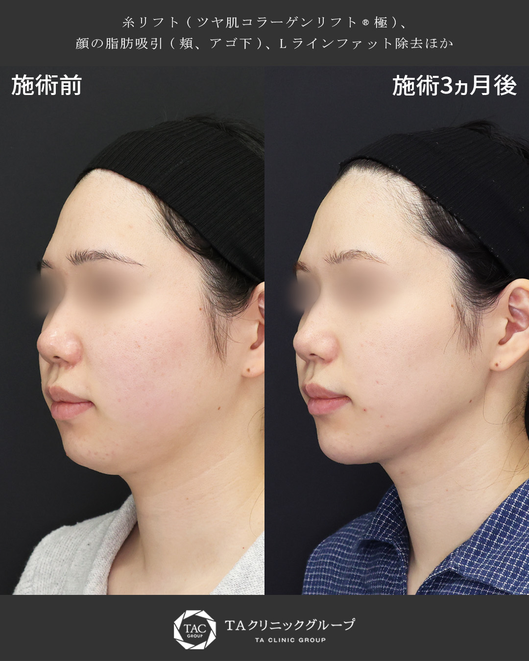 【脂肪吸引×糸リフト】気になる箇所だけピンポイントでスッキリ