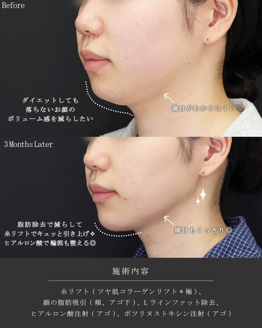 TAC式 ツヤ肌コラーゲンリフト®/Lラインファット除去（エラ下脂肪除去）/顎下の脂肪吸引・顔の脂肪吸引の症例写真 施術前後 