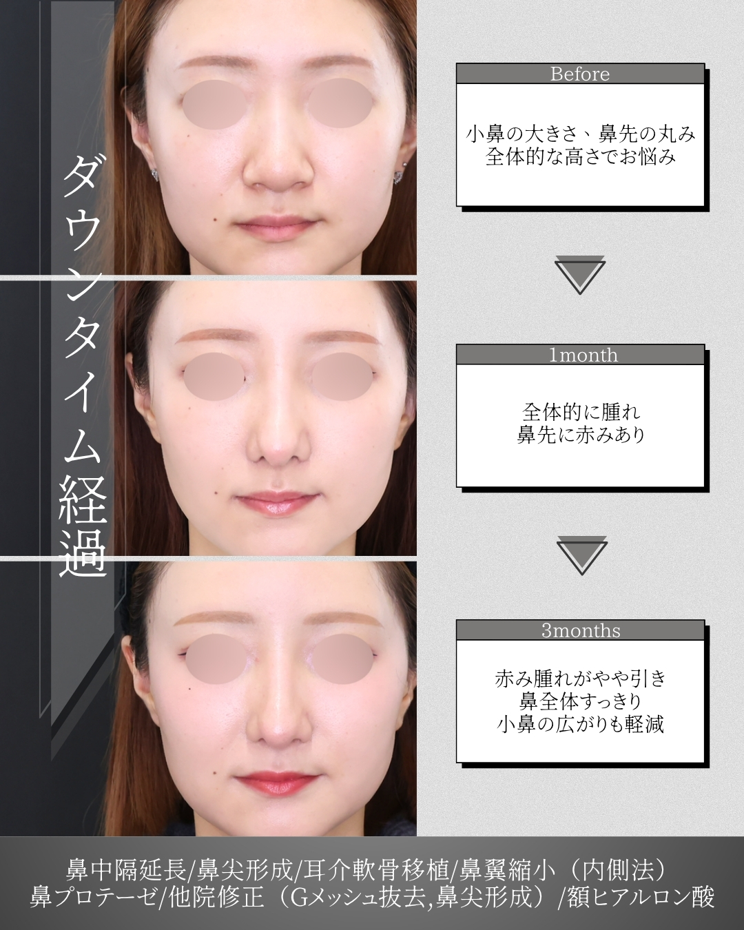 鼻中隔延長術/鼻先軟骨移植/鼻尖形成・鼻尖縮小の症例写真 施術前後 