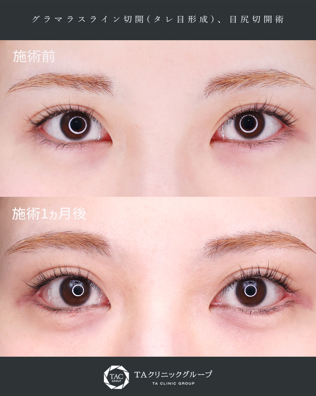 グラマラスライン（タレ目形成）/目尻切開術の症例写真 施術前後 