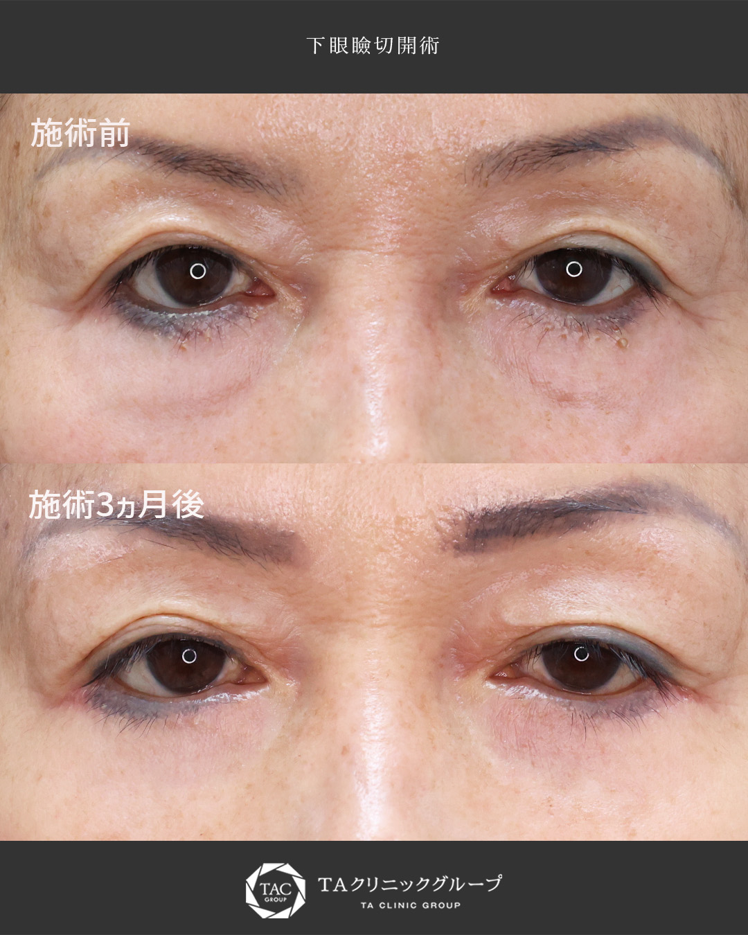 【目の下のたるみ取り】若々しいお目元に