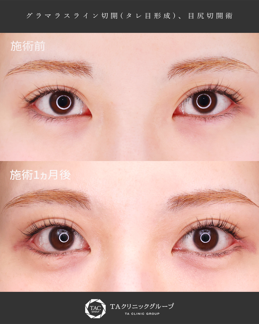自然さを保ったまま、限界まで大きく【目元複合施術】