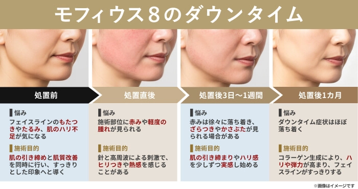 モフィウス8のダウンタイム経過（施術前・直後・1週間後・1ヶ月後の変化を示した症例イメージ）