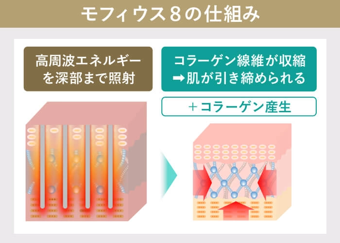 モフィウス8の仕組み（高周波エネルギーでコラーゲン収縮と生成を促し肌を引き締める）