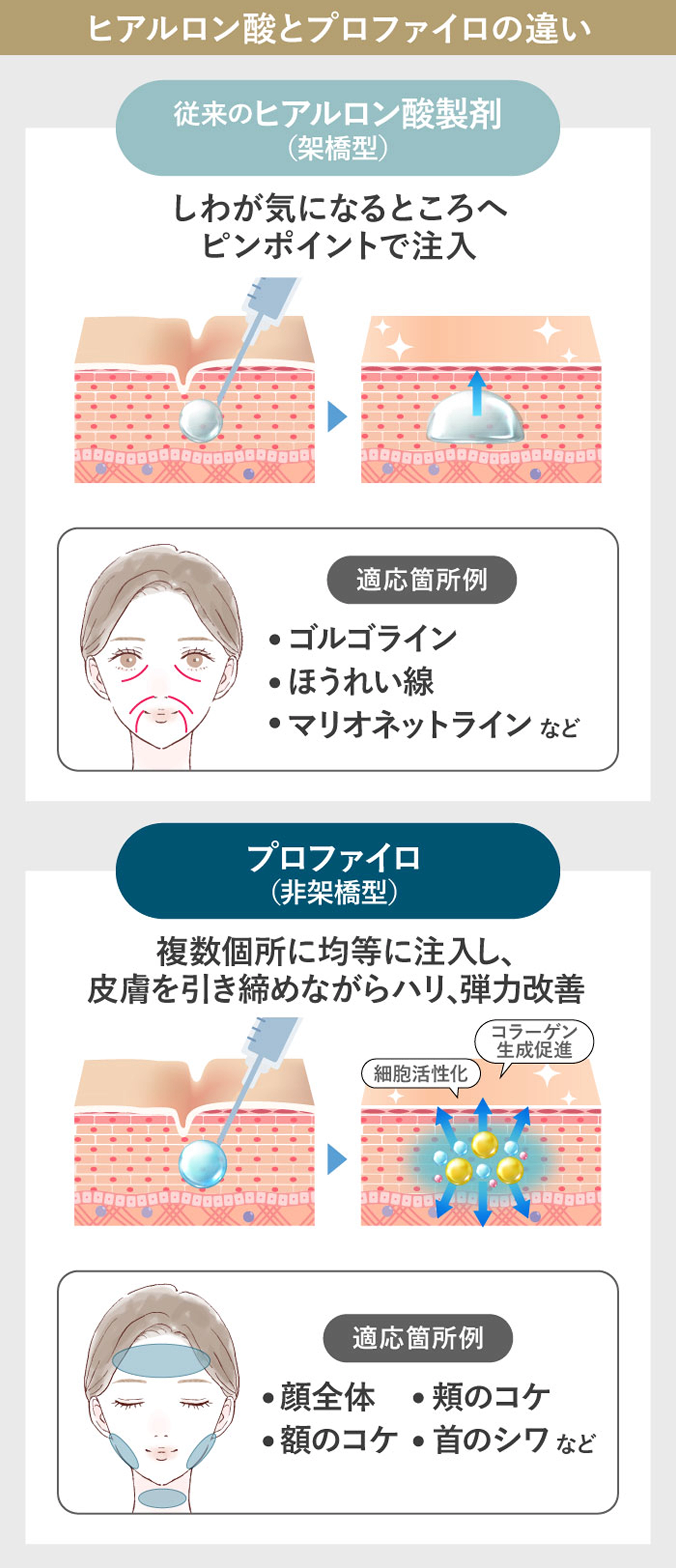ヒアルロン酸とプロファイロの違いについての説明
