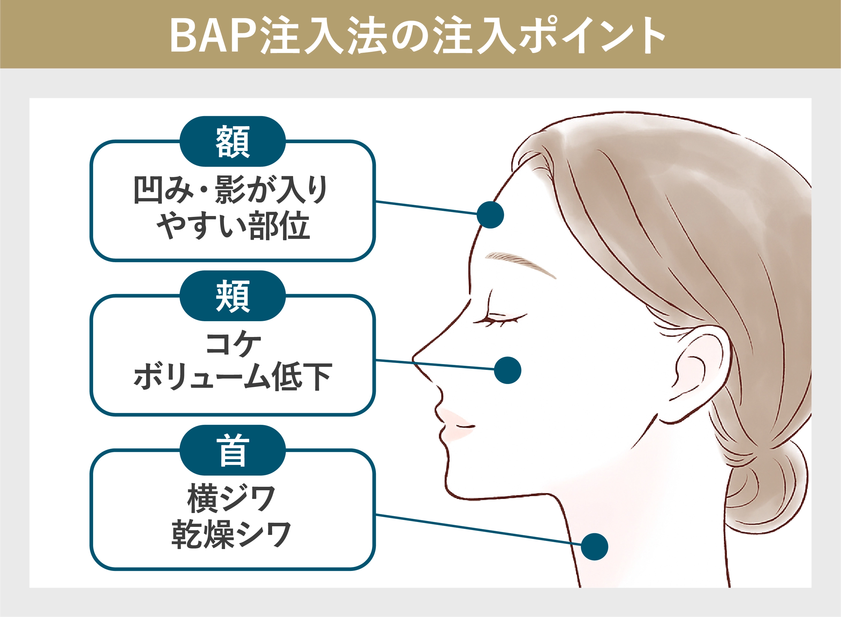 BAP注入法の注入ポイントのイラスト 額 頬 首
