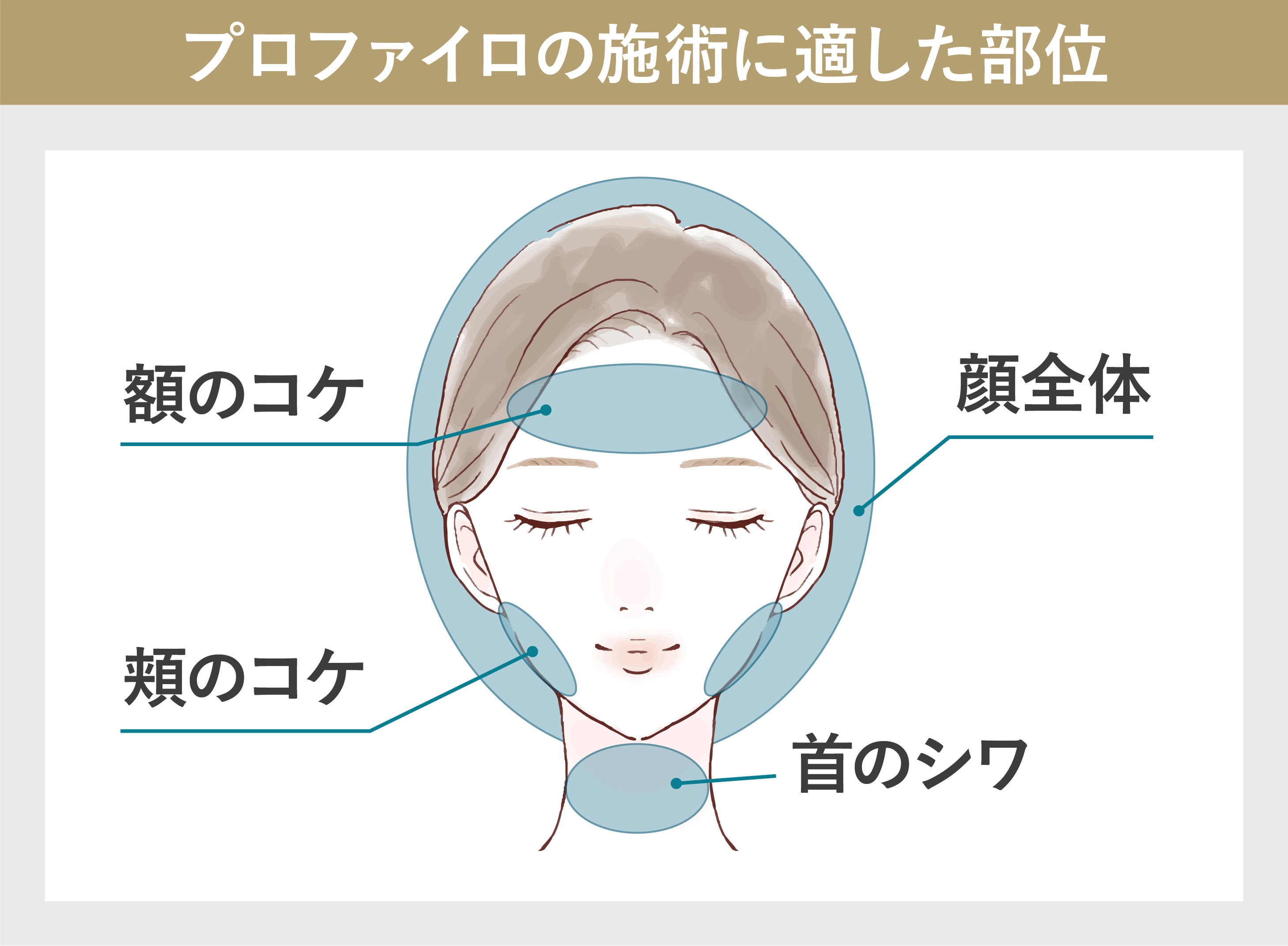 プロファイロの施術に適した部位のイラスト 顔全体 額のコケ 頬のコケ 首のシワ