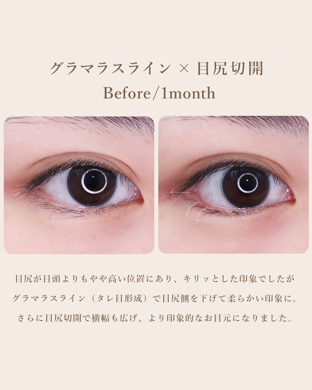 グラマラスライン（タレ目形成）/目尻切開術の症例写真 施術前後 