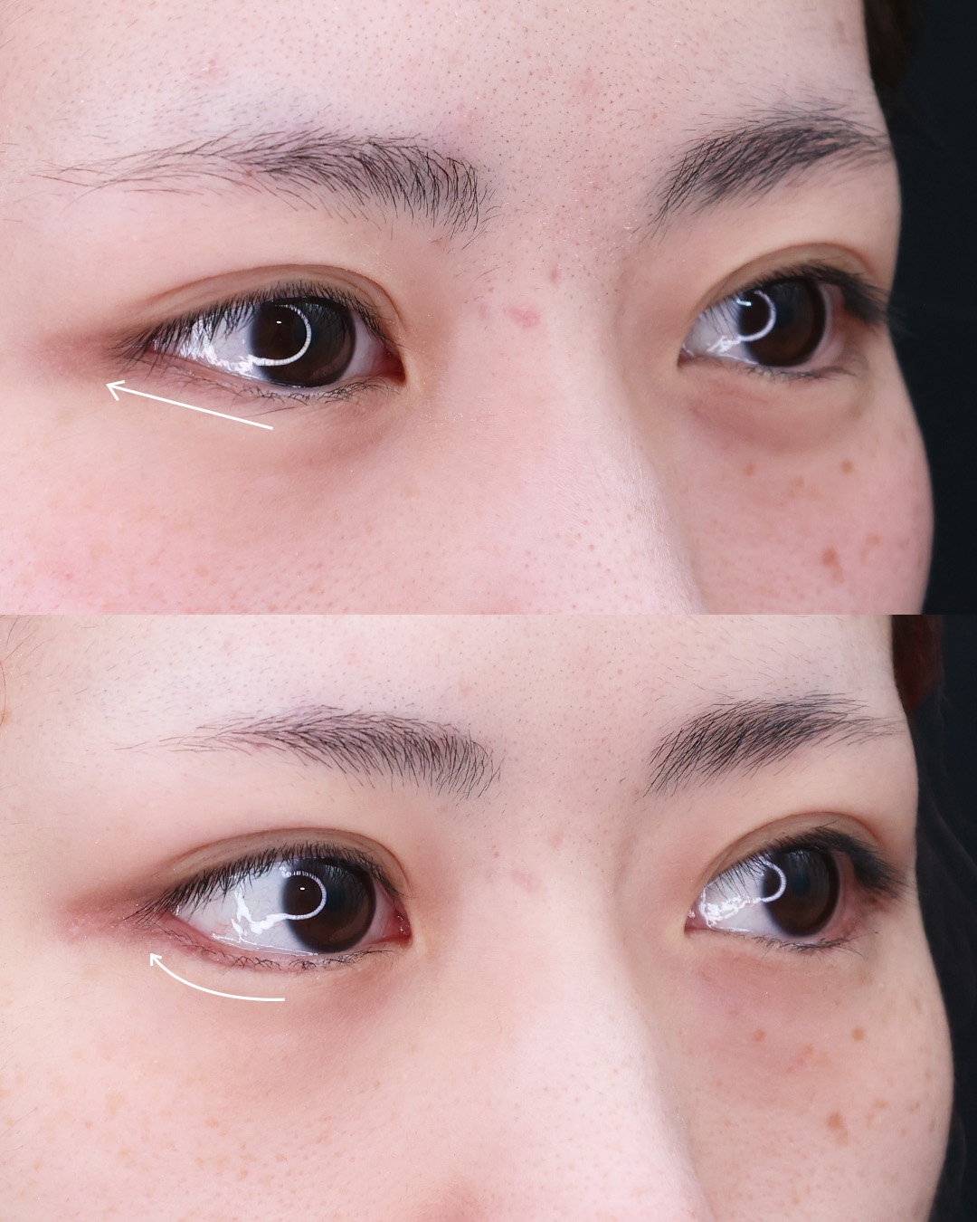 グラマラスライン（タレ目形成）/目尻切開術の症例写真 施術前後 