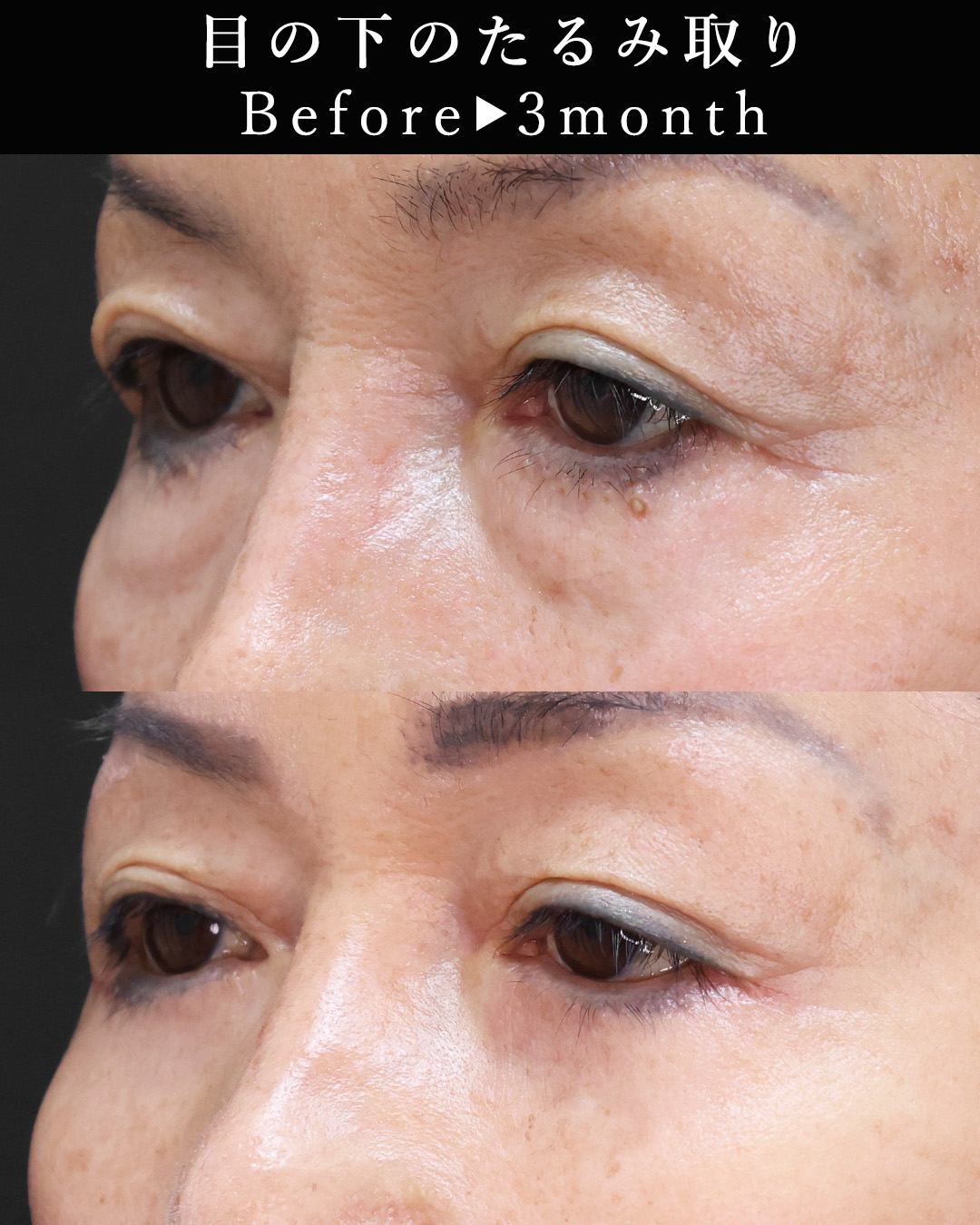 下眼瞼切開術（クマ・たるみとり）の症例写真 施術前後 