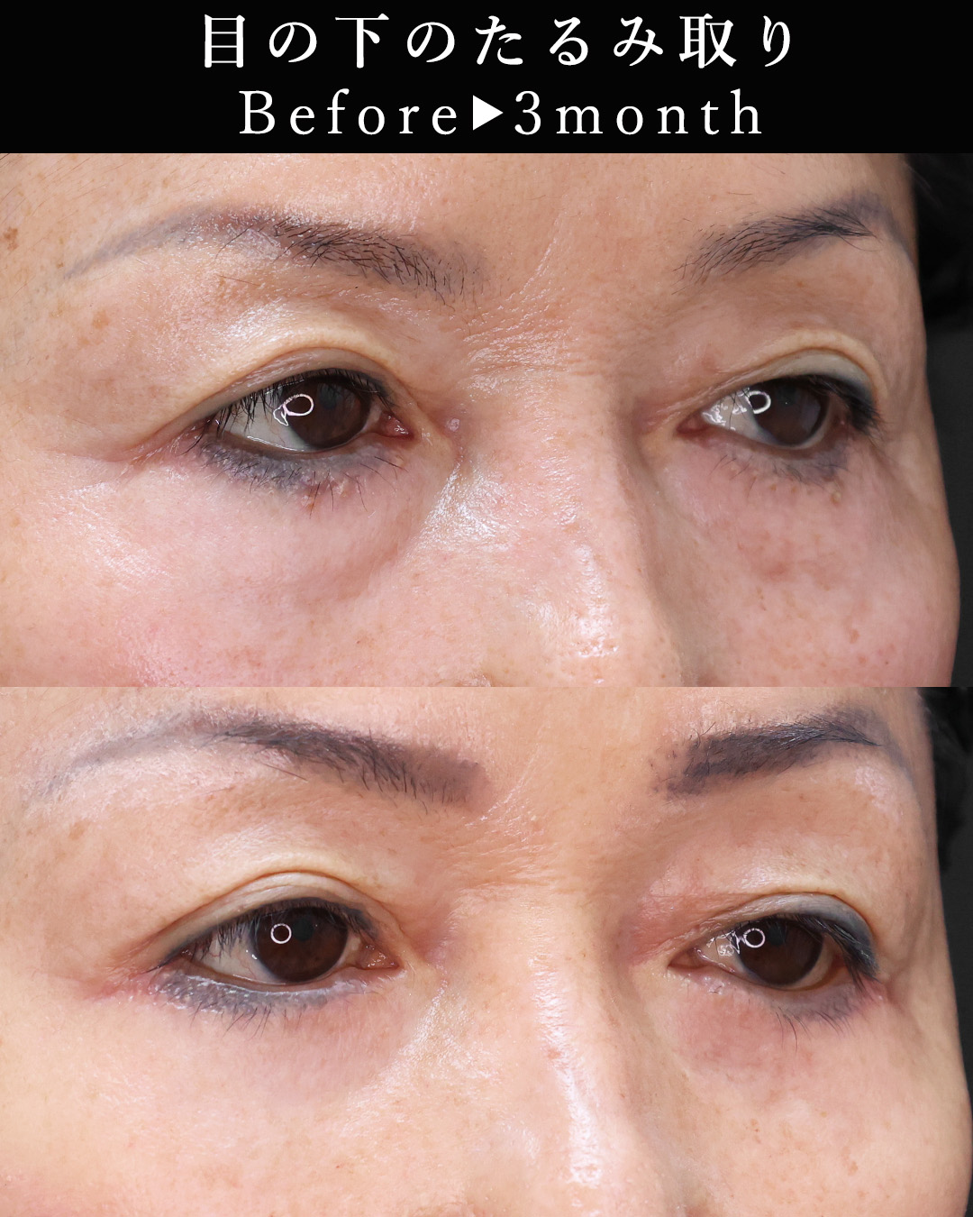 下眼瞼切開術（クマ・たるみとり）の症例写真 施術前後 