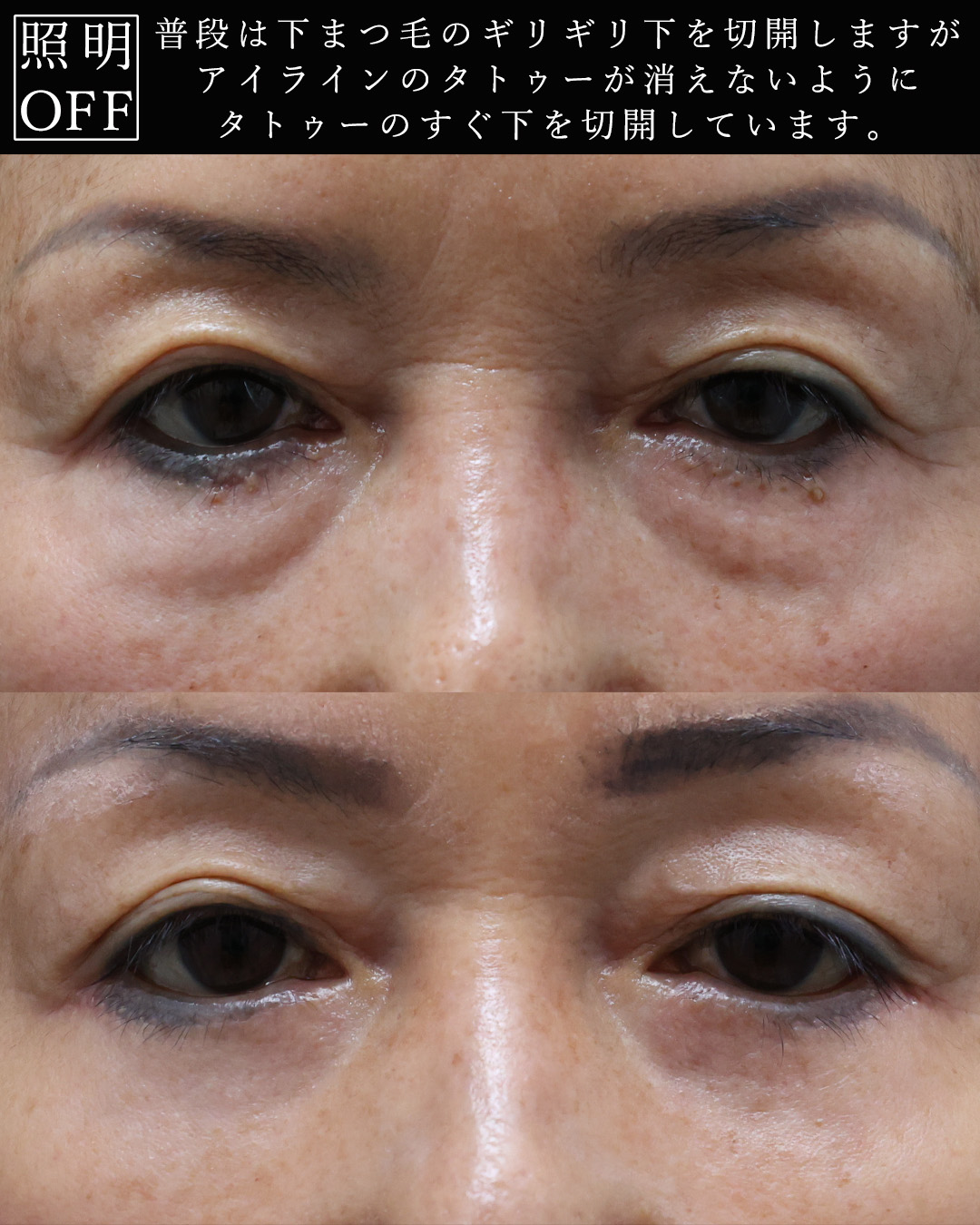 下眼瞼切開術（クマ・たるみとり）の症例写真 施術前後 
