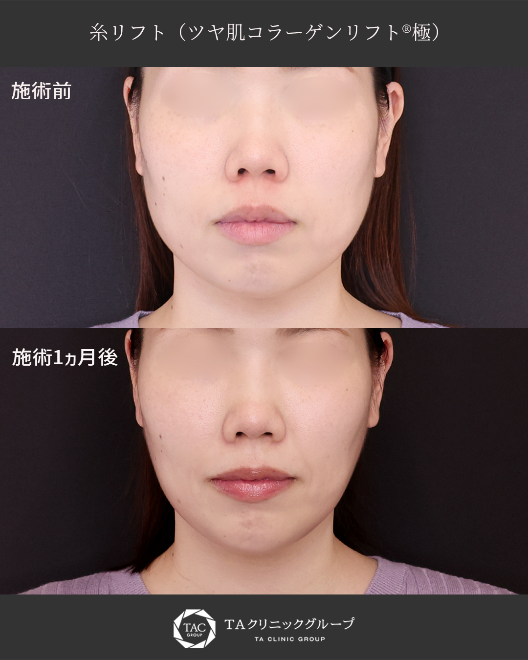 【糸リフト】〝やり過ぎ感″を抑えた自然なフェイスライン