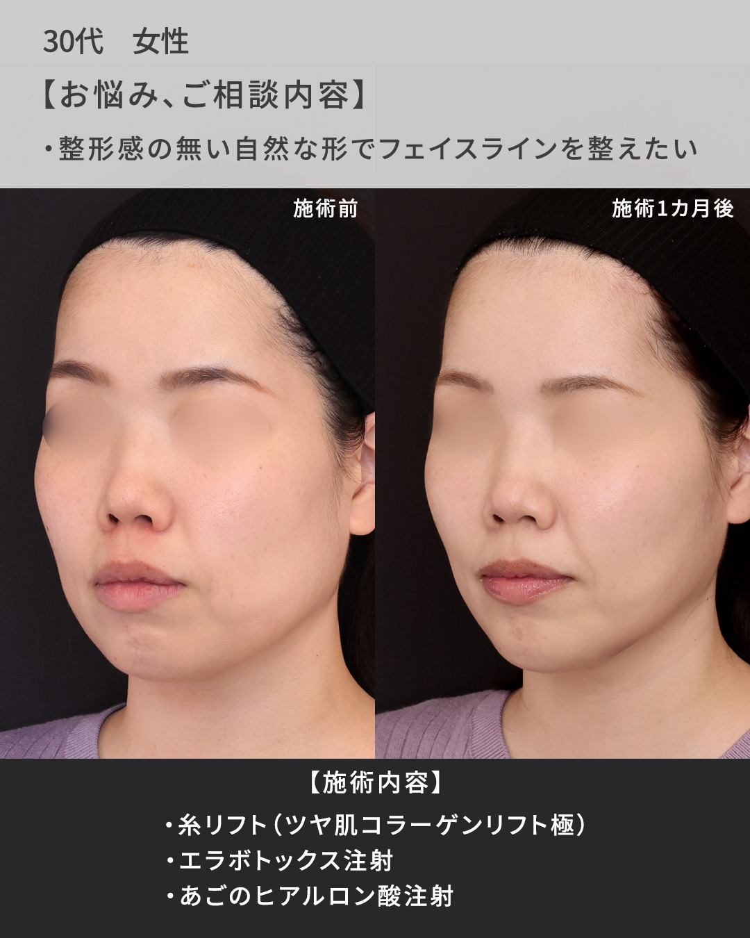 TAC式 ツヤ肌コラーゲンリフト®/ボトックス注射：その他/顎のヒアルロン酸注射の症例写真 施術前後 