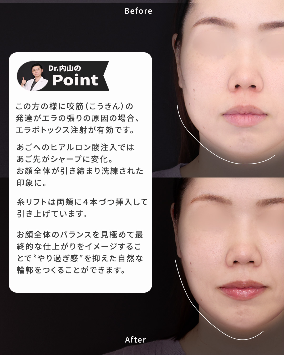 TAC式 ツヤ肌コラーゲンリフト®/ボトックス注射：その他/顎のヒアルロン酸注射の症例写真 施術前後 