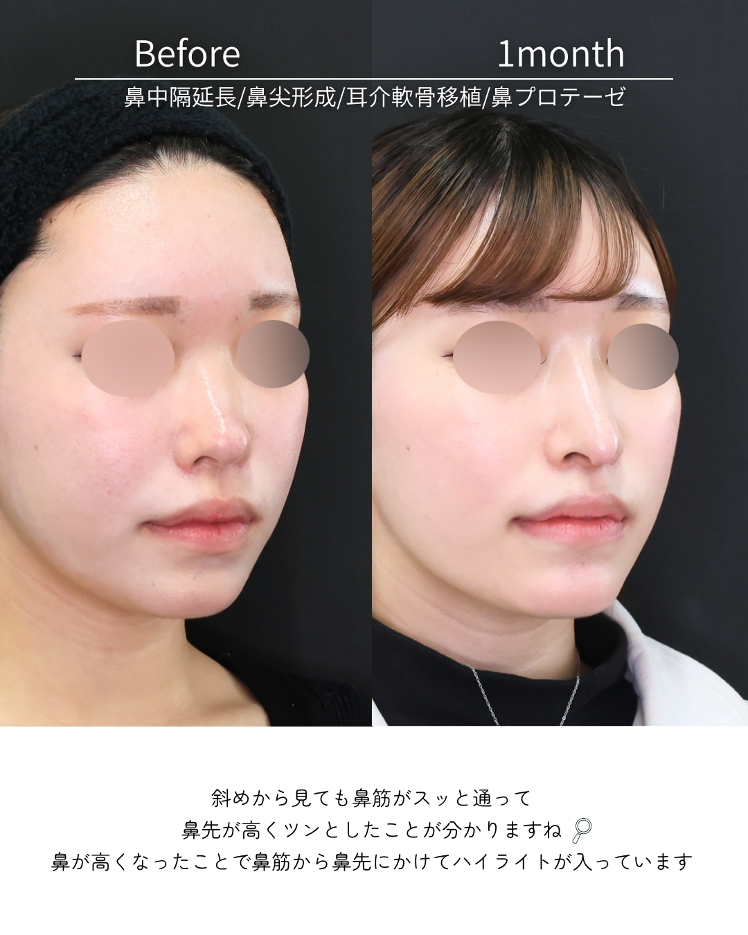 鼻中隔延長術/鼻尖形成・鼻尖縮小/鼻先軟骨移植の症例写真 施術前後 