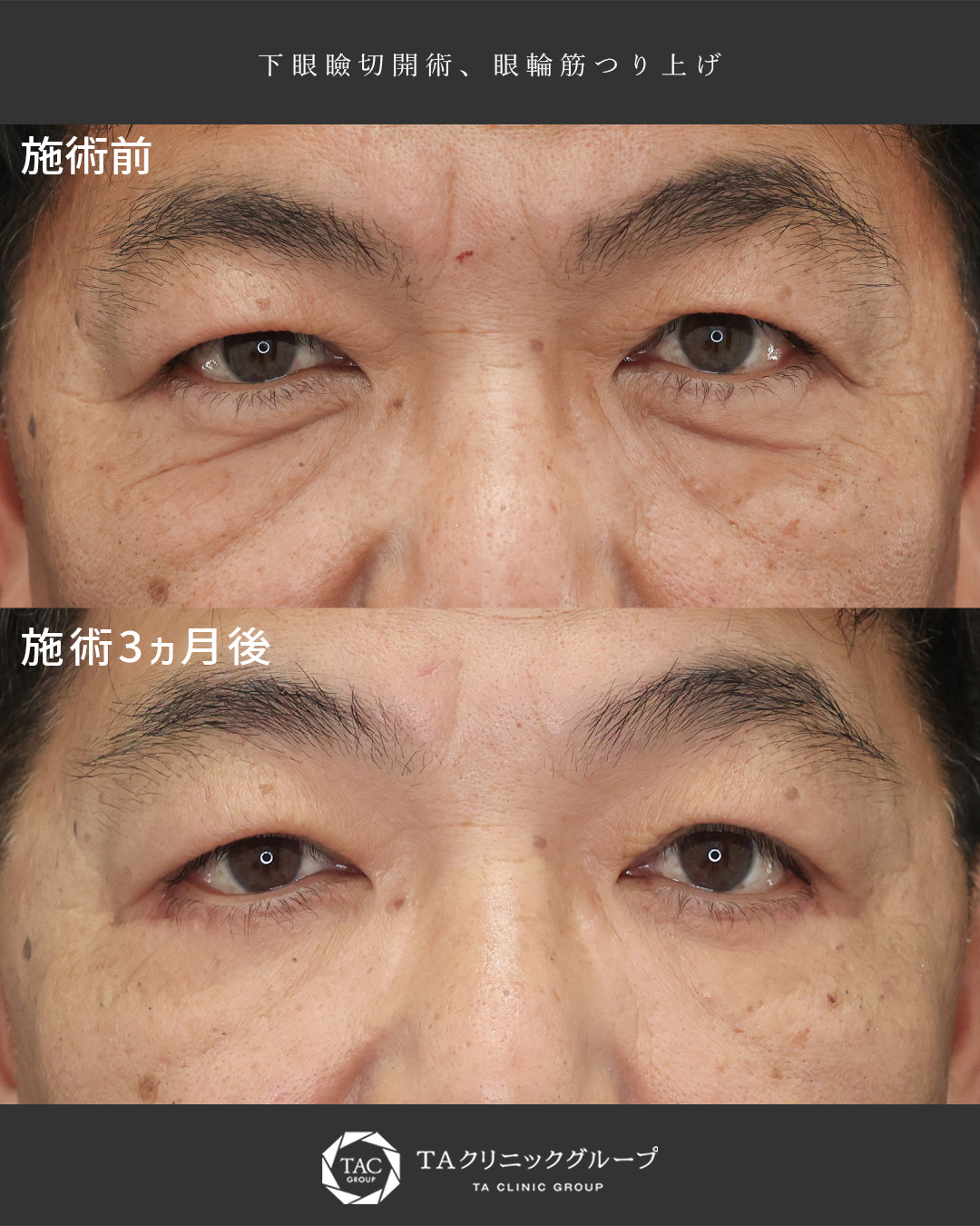 50代の男性会社員｜初めてのクマ取りで疲れた印象を改善