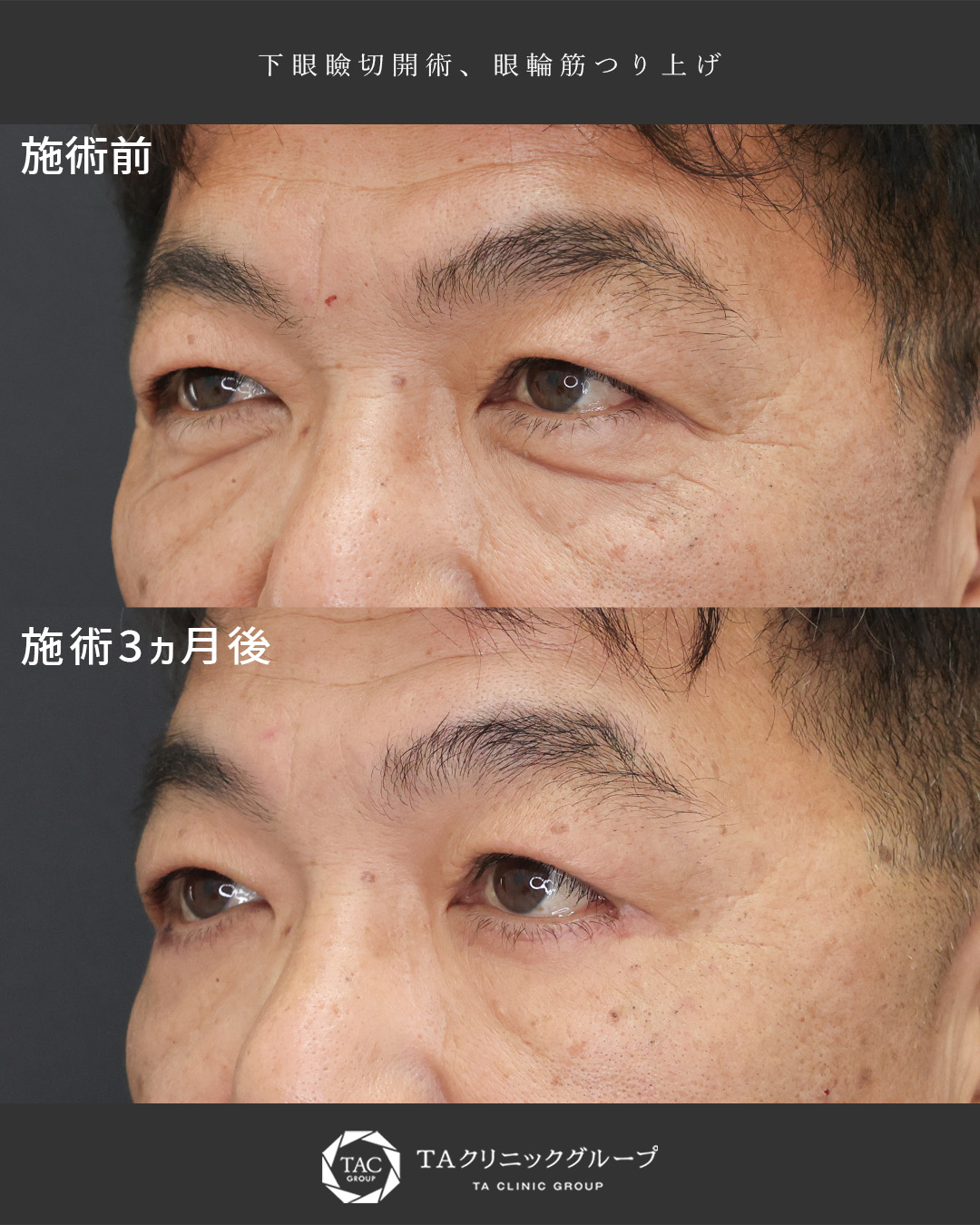 下眼瞼切開術（クマ・たるみとり）の症例写真 施術前後 