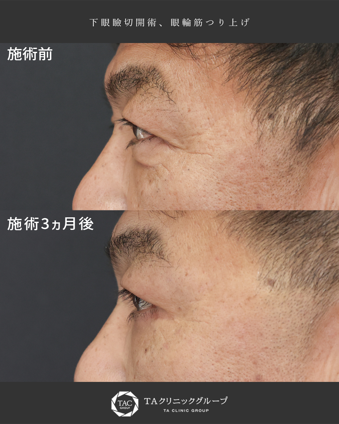 下眼瞼切開術（クマ・たるみとり）の症例写真 施術前後 