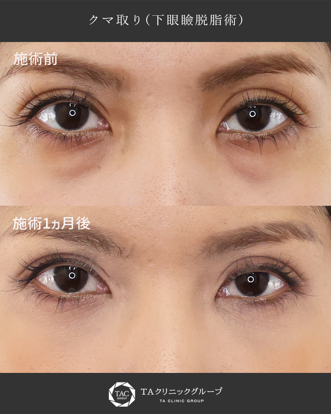 下眼瞼脱脂術（目の下のたるみ取り・目の下の脂肪ふくらみ取り）の症例写真 施術前後 