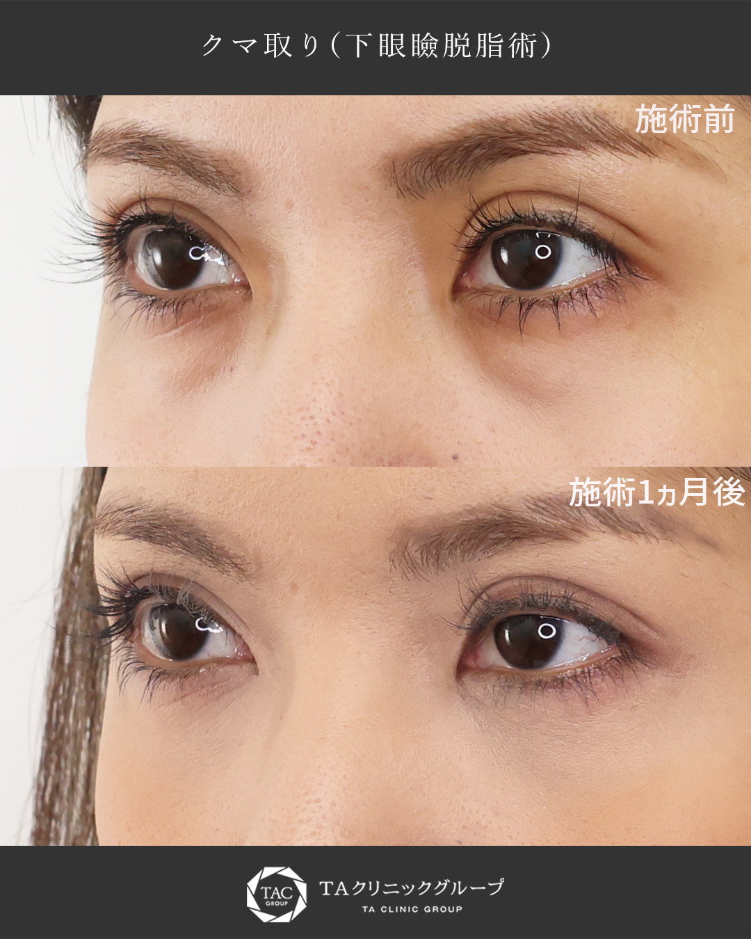 下眼瞼脱脂術（目の下のたるみ取り・目の下の脂肪ふくらみ取り）の症例写真 施術前後 