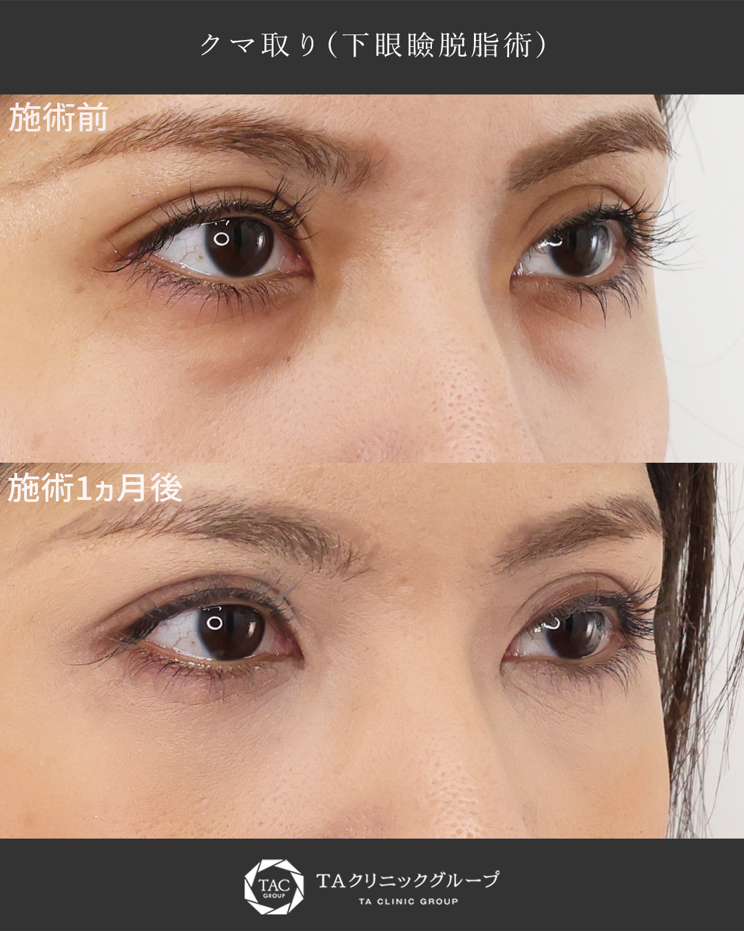 下眼瞼脱脂術（目の下のたるみ取り・目の下の脂肪ふくらみ取り）の症例写真 施術前後 