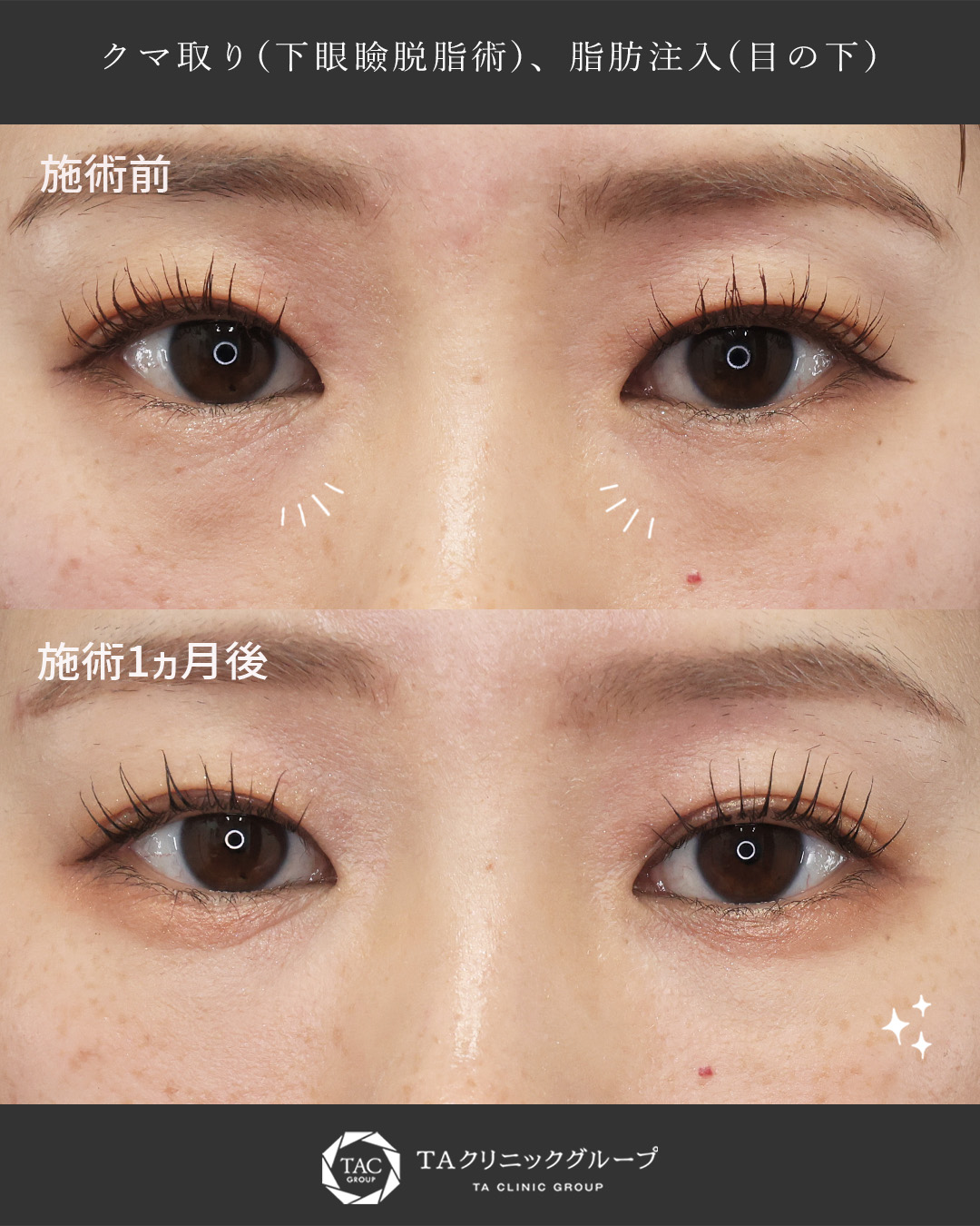 下眼瞼脱脂術（目の下のたるみ取り・目の下の脂肪ふくらみ取り）/顔の脂肪注入(コンデンスリッチフェイス)の症例写真 施術前後 